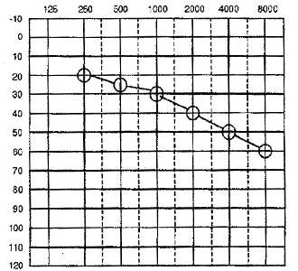 Gradually-Slopping-Audiogram