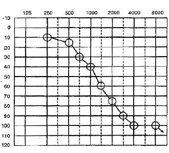 Precipitously-Slopping-Audiogram