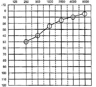 Rising-Audiogram