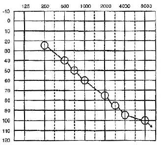 Sharply-Sloping-Audiogram