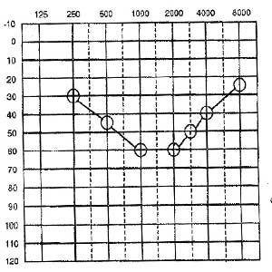 Trough-Audiogram