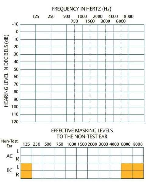 Pure Tone Audiogram Symbols Configuration Interpretation