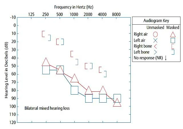 mixed-hearing-loss-audiogram