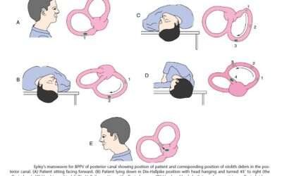 Disorders of Vestibular System