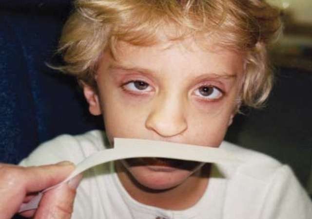 Assessment of Persons with Cleft Lip and Palate